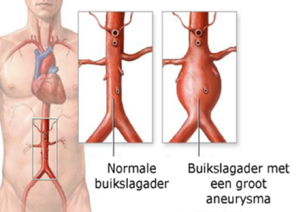 Afbeelding2 buikslagader