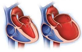 Figuur_Cardiomyopathie_item5